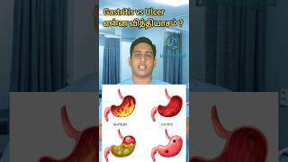 அல்சர் இரைப்பை அழற்சி என்ன வித்தியாசம்Gastritis vs Ulcer differencePangastritisulcer gastritis [upl. by Namurt]