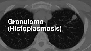 Classic Case Granuloma from Histoplasmosis [upl. by Ainaznat]