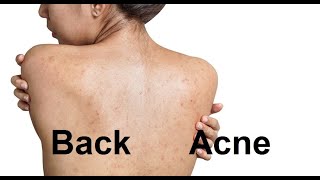 Back acne Pathology  Etiology  Pathogenesis  Clinical manifestations  Diagnosis amp Treatment [upl. by Ymerej]