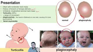 Fibromatosis Colli  pediatric ultrasound  DrMohamed Soliman [upl. by Naesal]