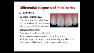 Caries of enamel  Initial caries [upl. by Jet]