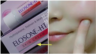 ELOSONEHT SKIN CREAM  SIDE EFFECTS  Pigmentation Killer [upl. by Myrtie]