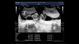 Missed abortion with multiple fetal anomalies [upl. by Jade]