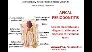 lecture Apical periodontitis [upl. by Yelnahs]