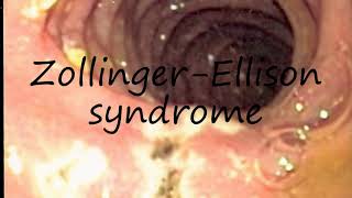 How to Pronounce ZollingerEllison syndrome [upl. by Harness]