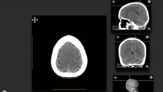 ImagingAnatomycom  CT Cerebrum  Part 1 [upl. by Pelag736]