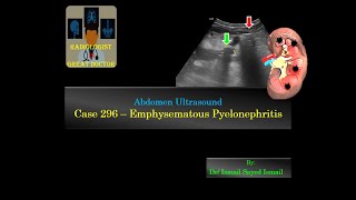 Ultrasound Case 296  Emphysematous Pyelonephritis [upl. by Almeeta]