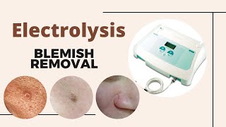 Advanced Electrolysis to remove thread veins milia skin tags cherry angiomas moles and more [upl. by Inad341]