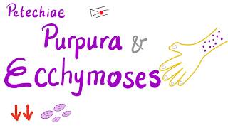 Petechiae Purpura and Ecchymoses [upl. by Neelyak533]