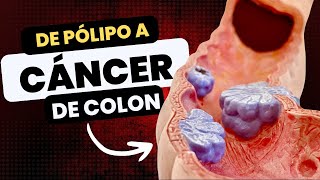 Los Pólipos en el COLON Se Pueden Convertir en CÁNCER [upl. by Fabe]