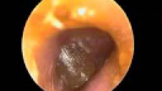 Acute Otitis media tympanic blister [upl. by Olbap]