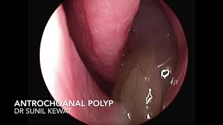 Antro Choanal Polyp  Nasal Endoscopy [upl. by Hsihsa489]