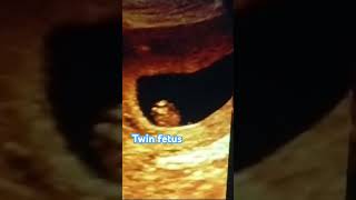 Ultrasound of fetal well being Twin CRL Monochronic amp Monoamnotic youtubeshorts shorts pregnacy [upl. by Ikkiv846]