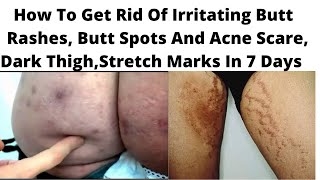 How to Get Rid of Butt Acne Fast How To Remove Dark Spots Pimples Acne Scars  Clear dark Thigh [upl. by Athiste]