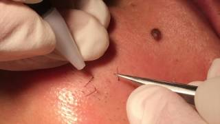 Electrolysis hair removal close up [upl. by Meela]