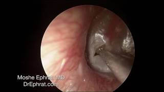 ENDOCSOPIC MUCOID OTITIS MEDIA DRAINAGE [upl. by Aehta]