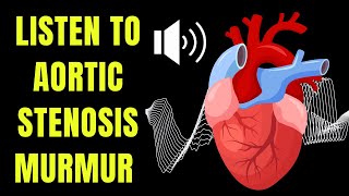 Doctor explains AORTIC STENOSIS including real heart SOUNDS of the murmur [upl. by Suehtomit]