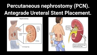 cathlab nursing kidneydisease nephrology DJstenting  Antegrade Ureteral Stent Placement [upl. by Elttil]