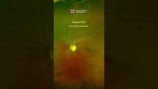 Retinal Tear Retinal Laser Photocoagulation eyes retinal eyedisease doctor eyedisorder [upl. by Thomasina]