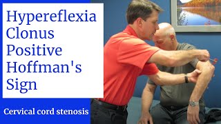 Hyperreflexia Clonus Positive Hoffmans Sign Central Cervical Spine Stenosis [upl. by Esyned]