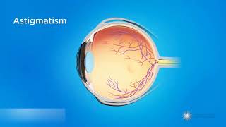 Astigmatisme  Flou visuel et déformation ovale de la cornée ou de lœil [upl. by Gluck]