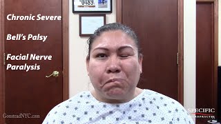 Chronic Severe Bells Palsy Facial Nerve Paralysis HELPED by Dr Suh Specific Chiropractic [upl. by Sergeant724]