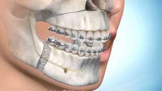Chirurgische kaakcorrectie onder en bovenkaak [upl. by Sairtemed]