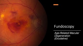 AgeRelated Macular Degeneration Exudative Fundoscopy [upl. by Anoel]