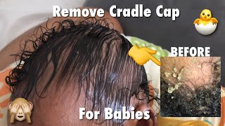 Completely Remove Cradle Cap Sped Up  Visual ASMR  No Music [upl. by Sixla]