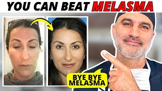 How Dr Amir Karam treated his wifes Melasma AT HOME Step by Step [upl. by Searcy]