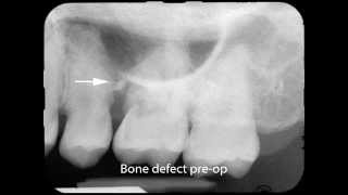 LANAP Laser Assisted New Attachment Procedure Part 2 [upl. by Atidnan]