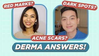 How to treat ACNE SCARS amp ACNE MARKS Dermatologist Answers Filipino  Jan Angelo [upl. by Enutrof696]