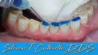 Bonding Worn Anterior Teeth  Dental Minute with Dr Steven T Cutbirth DDS [upl. by Lion]