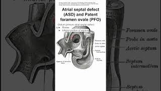 Atrial septal defect ASD and Patent foramen ovale PFO [upl. by Gaelan]