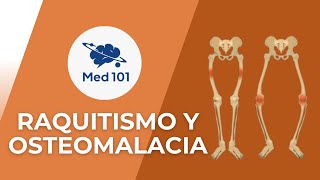 Raquitismo y osteomalacia 101 [upl. by Brita]