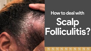 Dealing with Scalp Folliculitis Watch immediately [upl. by Ennairam]