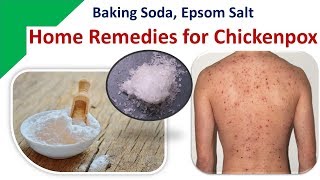 Home Remedies for Chickenpox  Baking Soda Epsom Salt [upl. by Kunkle]