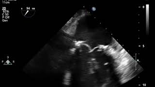 Mass Attachd to Mitral Valve Annulus via Chordae Tendineae  TEE [upl. by Skolnik]