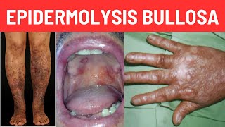 What is Epidermolysis Bullosa Causes Symptoms [upl. by Wayolle]