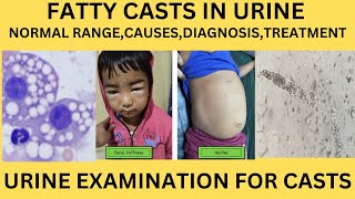 FATTY CAST IN URINECAUSES SYMPTOMS TREATMENT OF FATTY CASTS IN URINE EXAMINATION IN HINDI [upl. by Hogle]