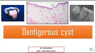 Dentigerous Cyst [upl. by Vedis31]