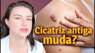 Como tratar uma cicatriz queloide ou hipertrófica antiga  Opinião de Esteticista [upl. by Atilehs205]