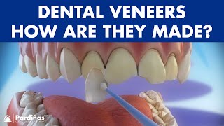 Veneers  How are they made Preparation and placement of cosmetic dentistry veneers © [upl. by Bergmann175]