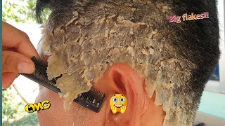 Psoriasis Scalp Removal At Home 350 [upl. by Heer617]