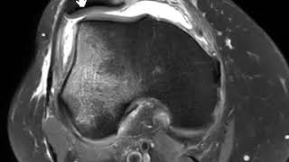 Transient patellar dislocation of knee [upl. by Rebma]