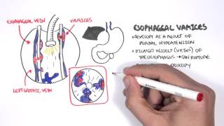 Upper GI Bleed Causes Overview [upl. by Ilan569]