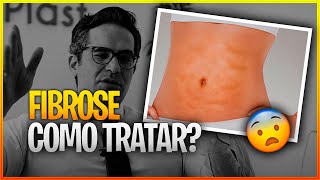 COMO TRATAR A FIBROSE APÓS LIPOASPIRAÇÃO 😨 [upl. by Eerat]