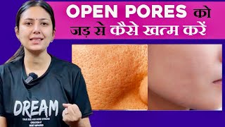 Open Pores का 100 इलाज सिर्फ 15 दिनों में  Home Remedies for Skin  Upasana ki Duniya [upl. by Romeu]