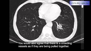 Rounded atelectasis  CT scan of Chest [upl. by Nueoras168]