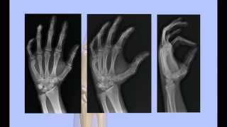 Boxers Fracture Closed Reduction [upl. by Ekaterina607]